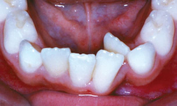 Crowding Charlestown Orthodontics in Charlestown, NSW