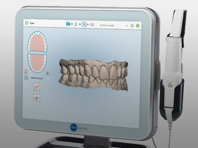 Digital Impressions at Charlestown Orthodontics in Charlestown, NSW