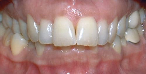 Overbite Charlestown Orthodontics in Charlestown, NSW