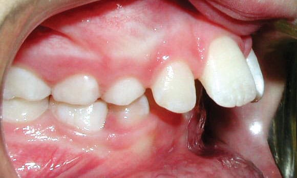 Protrusion Charlestown Orthodontics in Charlestown, NSW