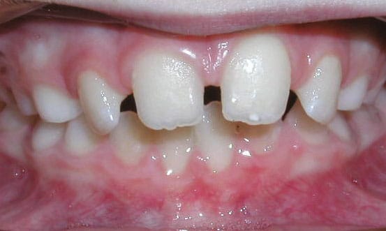 Spacing Charlestown Orthodontics in Charlestown, NSW