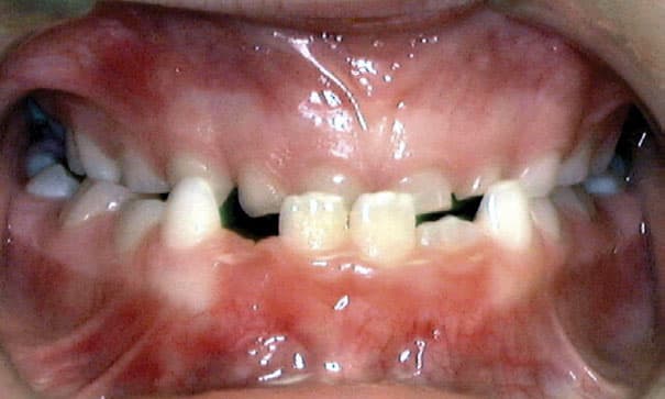 Underbite Charlestown Orthodontics in Charlestown, NSW